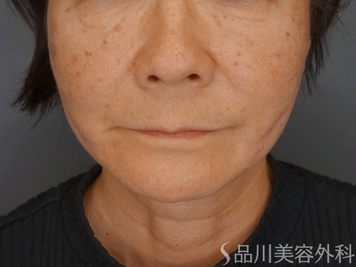 症例NO.74080のAFTER写真