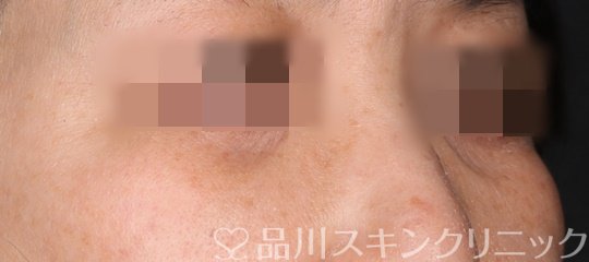 症例NO.71307のAFTER写真