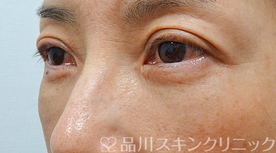 症例NO.69111のAFTER写真