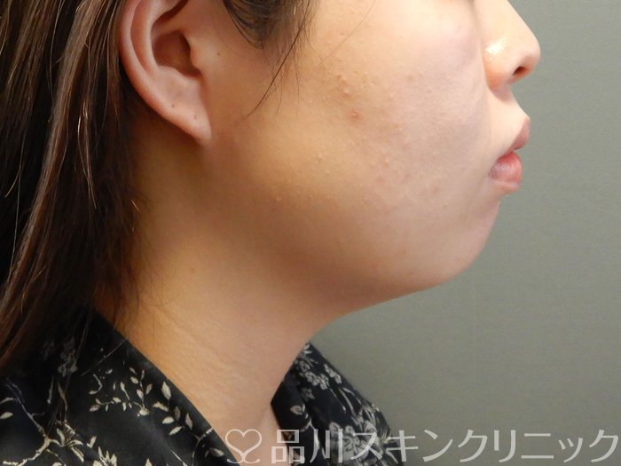 症例NO.62168のBEFORE写真
