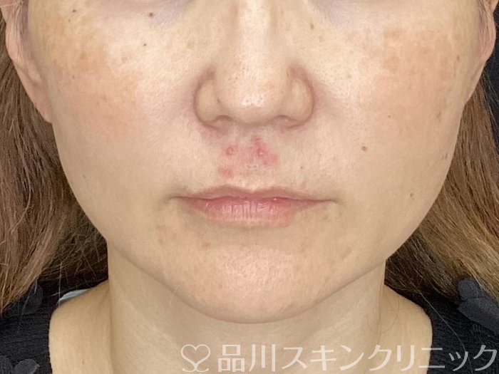 症例NO.72496のBEFORE写真