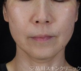 症例NO.71020のAFTER写真