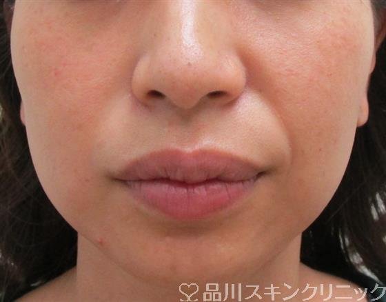 症例NO.31860のBEFORE写真