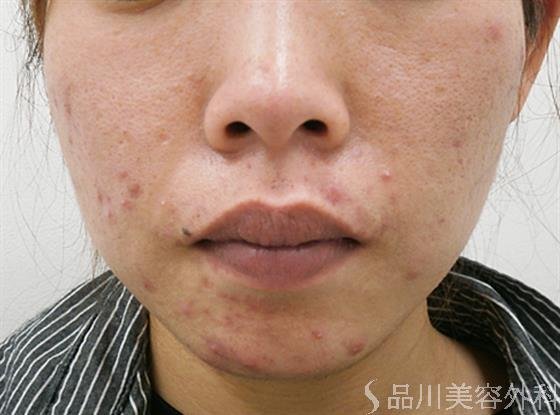 症例NO.31582のBEFORE写真