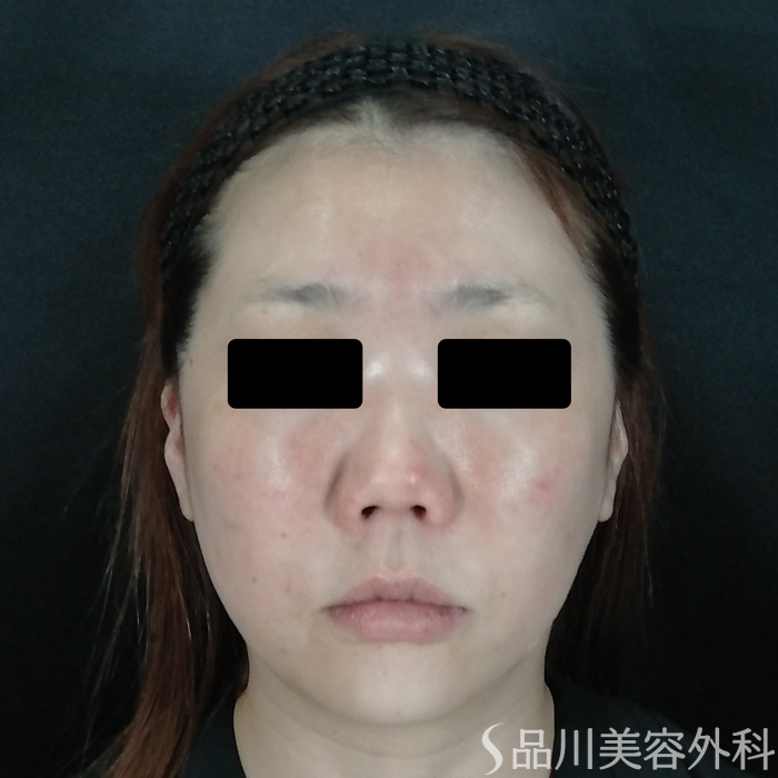 症例NO.72628のAFTER写真