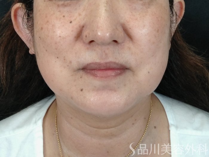 症例NO.70838のBEFORE写真