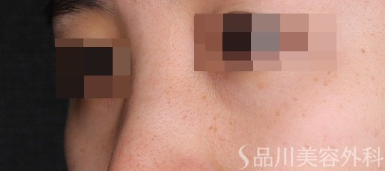 症例NO.74393のBEFORE写真