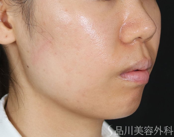 症例NO.71920のAFTER写真