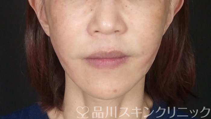 症例NO.72477のAFTER写真