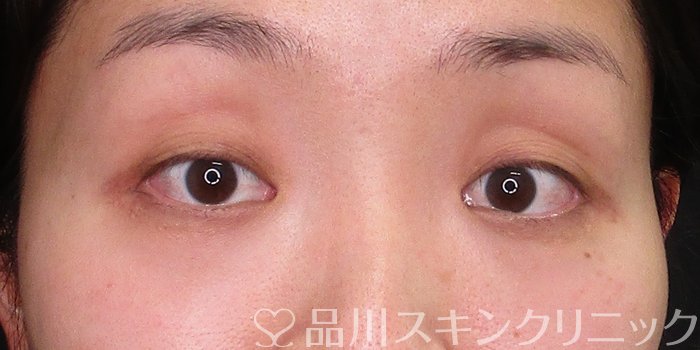 症例NO.70571のBEFORE写真