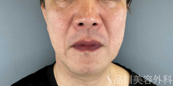 症例NO.65651のBEFORE写真