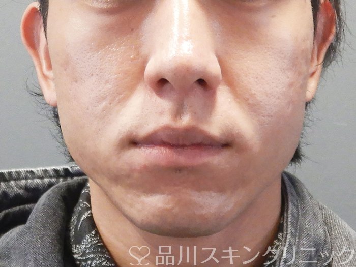 症例NO.73208のBEFORE写真