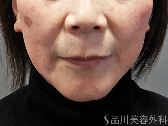 症例NO.70431のBEFORE写真