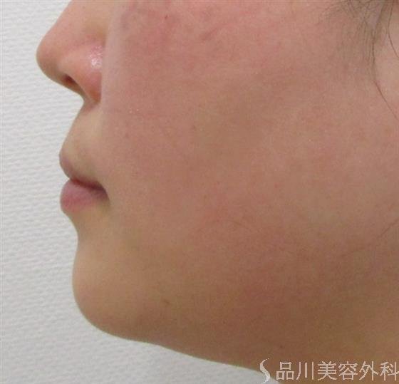 症例NO.43621のBEFORE写真