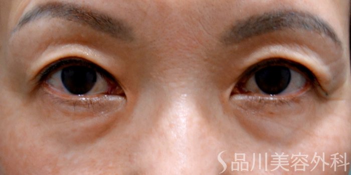 症例NO.73620のBEFORE写真