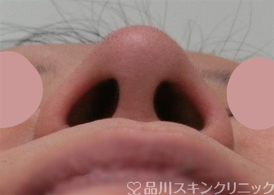 症例NO.27732のAFTER写真