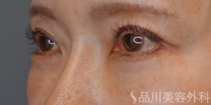 症例NO.73362のAFTER写真