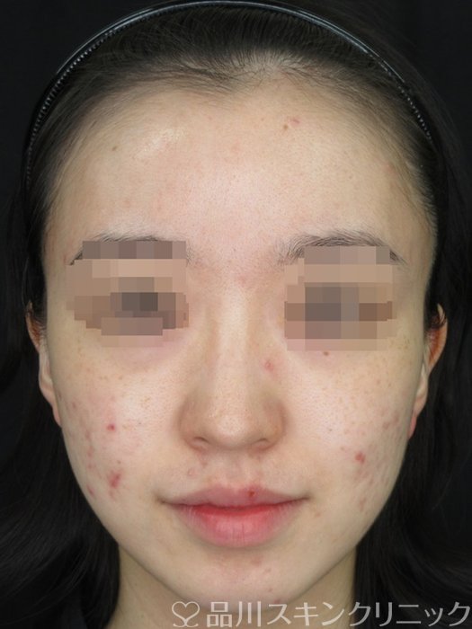 症例NO.72306のBEFORE写真