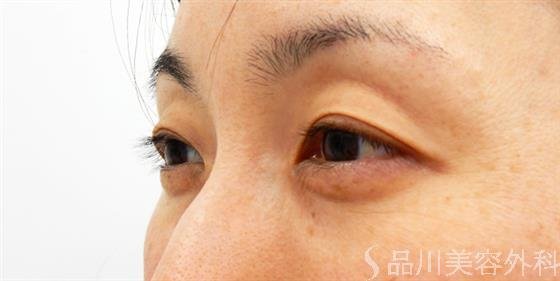 症例NO.53638のAFTER写真