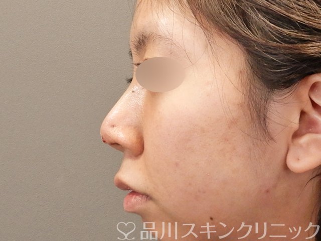 症例NO.75198のAFTER写真