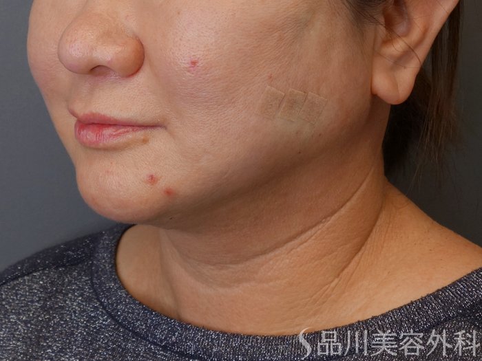 症例NO.72816のAFTER写真