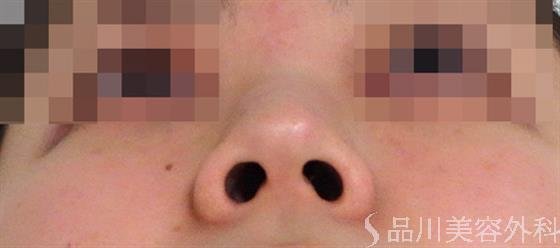 症例NO.36512のBEFORE写真