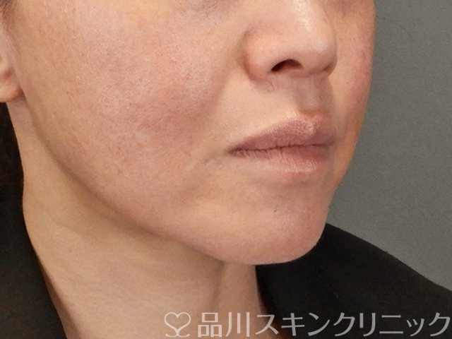 症例NO.75298のBEFORE写真