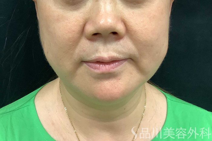 症例NO.71283のBEFORE写真