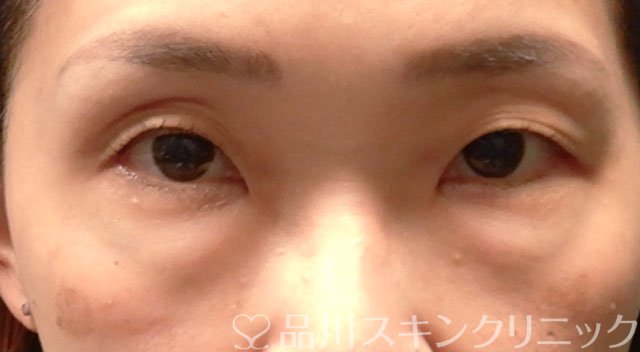 症例NO.63644のBEFORE写真