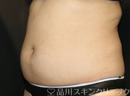 症例NO.73888のAFTER写真