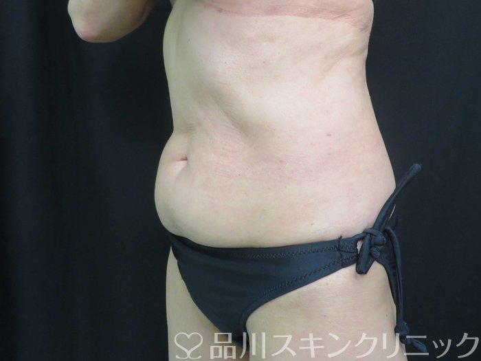 症例NO.74036のBEFORE写真