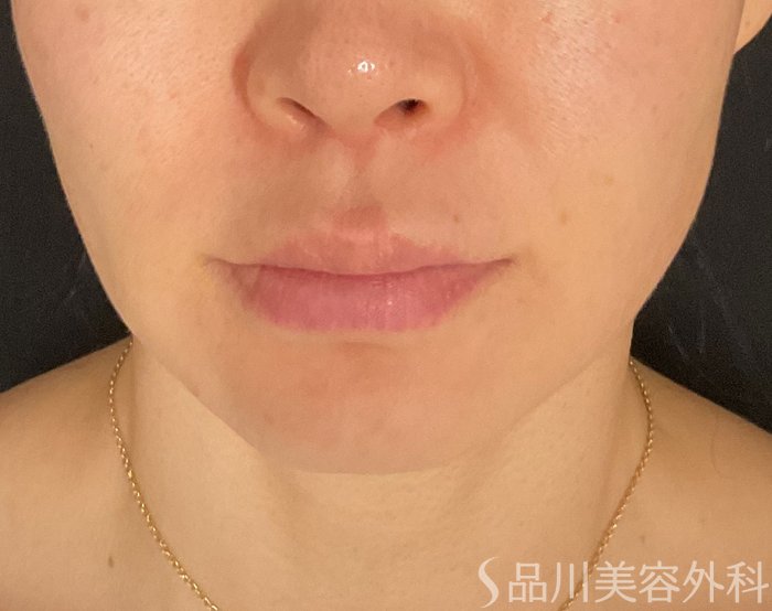 症例NO.75356のBEFORE写真