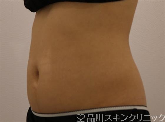 症例NO.43074のBEFORE写真