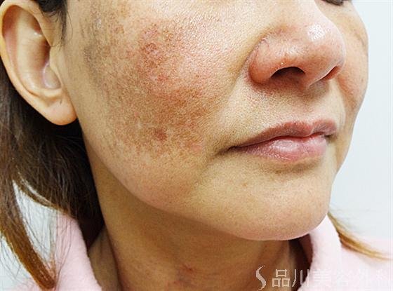 症例NO.13790のBEFORE写真
