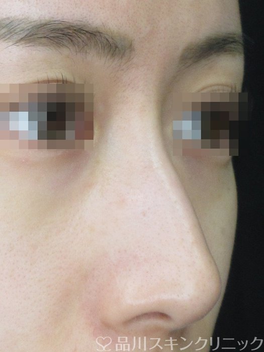 症例NO.69417のBEFORE写真