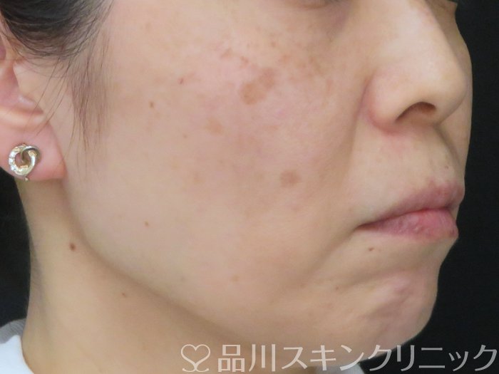 症例NO.74738のBEFORE写真