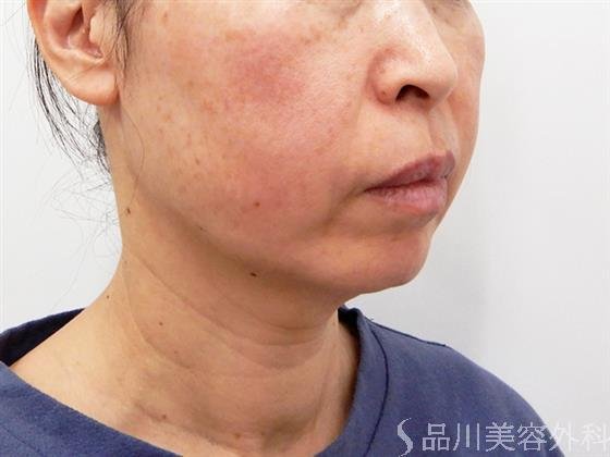 症例NO.53454のBEFORE写真
