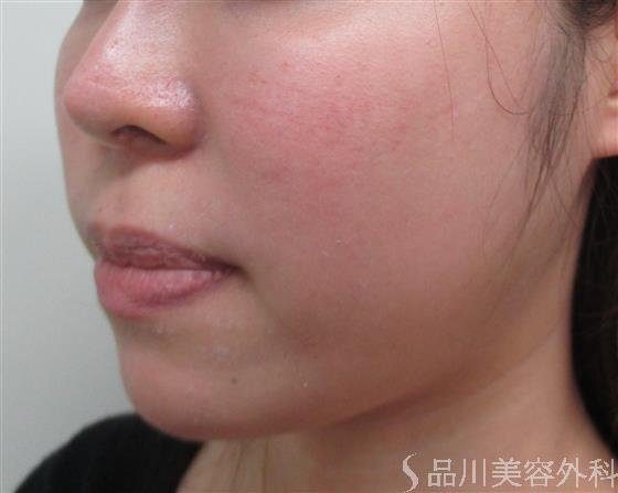 症例NO.29299のBEFORE写真