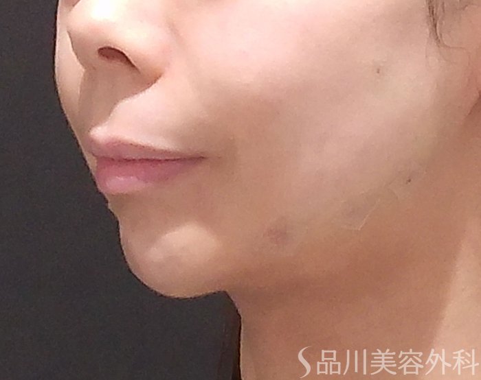 症例NO.69783のAFTER写真