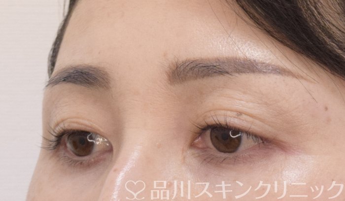 症例NO.75017のBEFORE写真