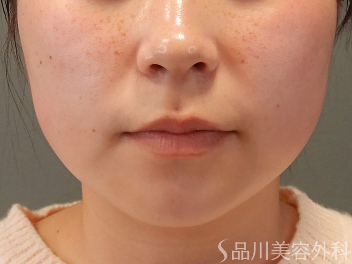 症例NO.71111のBEFORE写真