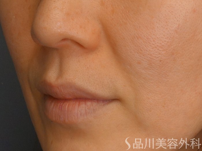 症例NO.67867のBEFORE写真