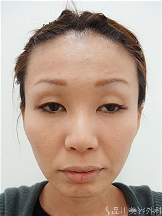 症例NO.26656のBEFORE写真