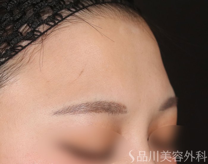 症例NO.73406のBEFORE写真