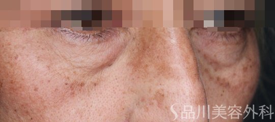 症例NO.68941のBEFORE写真