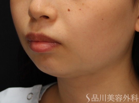 症例NO.69457のBEFORE写真