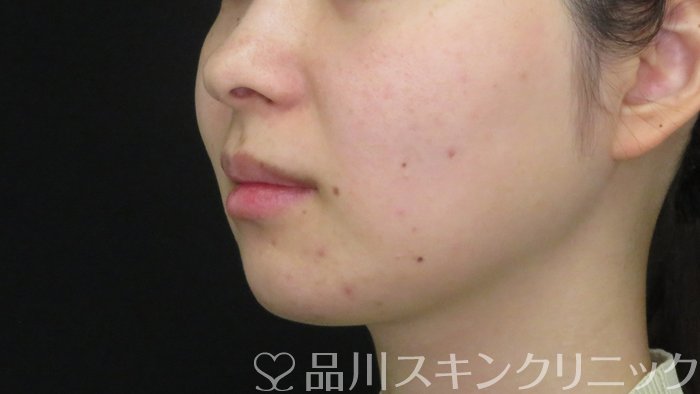 症例NO.72149のAFTER写真