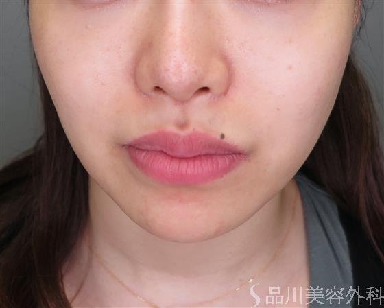 症例NO.48969のBEFORE写真
