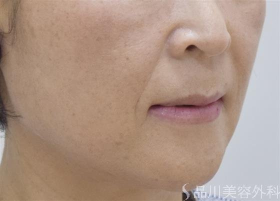 症例NO.49182のBEFORE写真