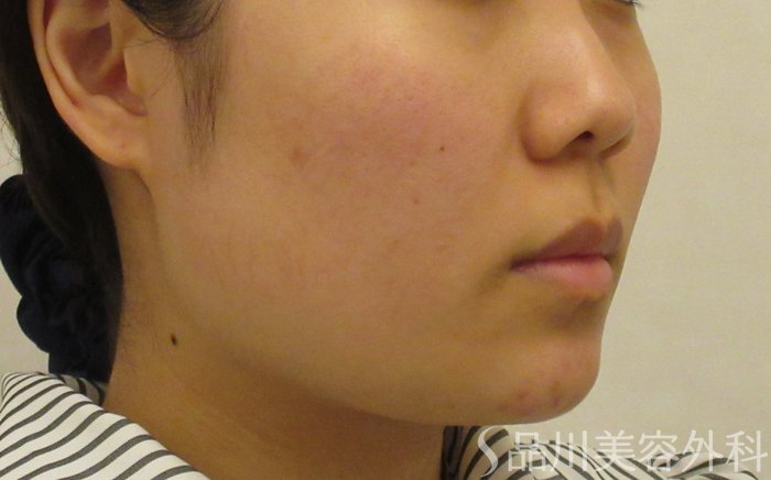症例NO.71464のBEFORE写真